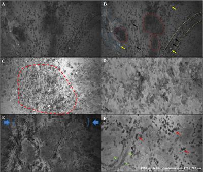 Ex Vivo Fluorescein-Assisted Confocal Laser Endomicroscopy (CONVIVO® System) in Patients With Glioblastoma: Results From a Prospective Study